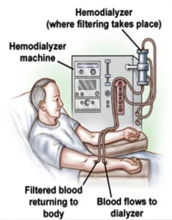 Hemodialysis Machine Process