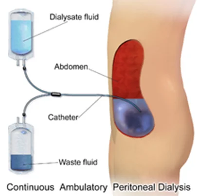 IPD/Peritoneal Dialysis Process