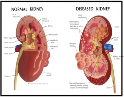 Major Kidney Disease